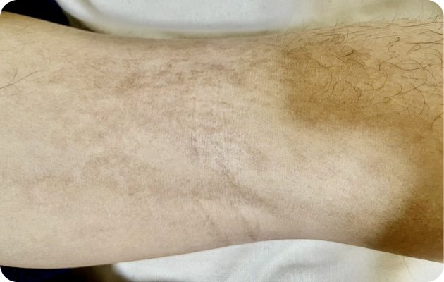 右足膝裏 After